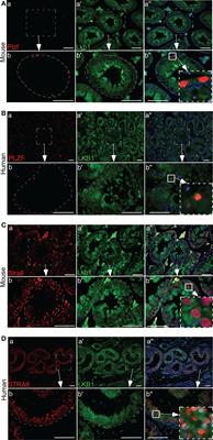 Loss of liver kinase B1 in human seminoma